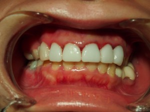 前歯の審美治療　