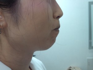 顎botox before