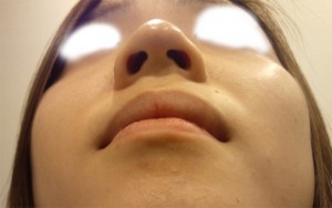団子鼻の整形