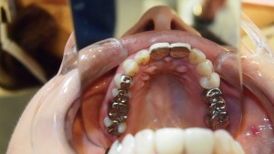 歯科用金属は体に有害！？！
