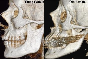 facial bone aging