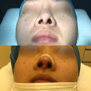鼻尖縮小術、鼻中隔延長術