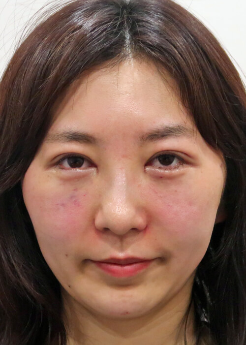 目の下のふくらみ たるみ諦めていませんか Facial Antiaging Dr Hideyoshi Blogdr Hideyoshi Blog