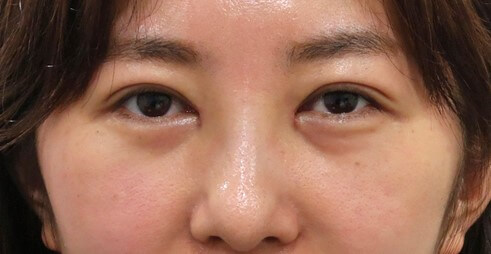 目の下のふくらみ たるみ諦めていませんか Facial Antiaging Dr Hideyoshi Blogdr Hideyoshi Blog