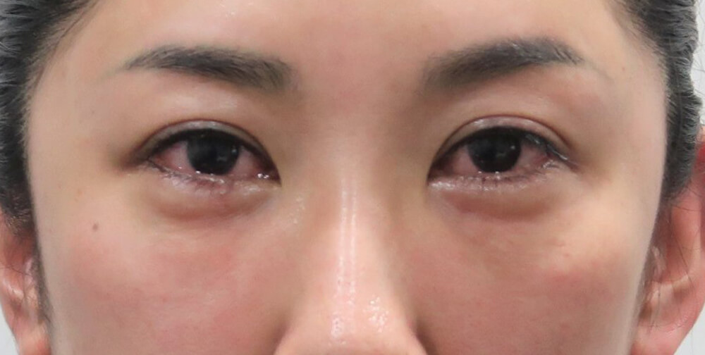目の下のふくらみ たるみ諦めていませんか Facial Antiaging Down Timeの経過編 Dr Hideyoshi Blogdr Hideyoshi Blog