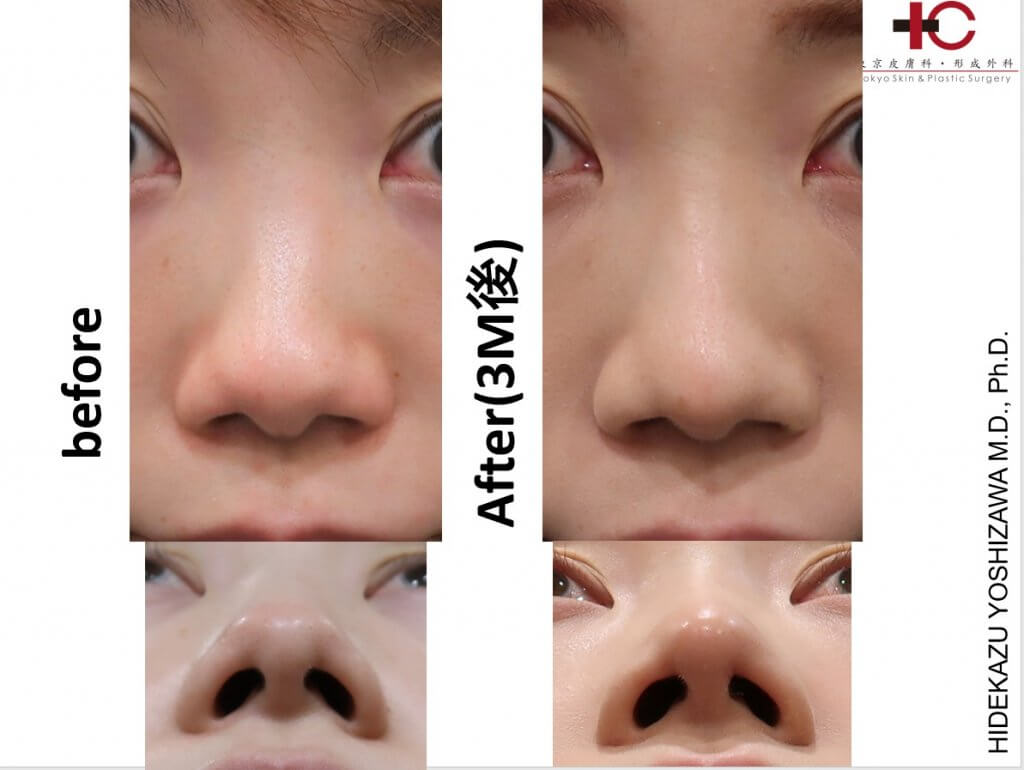 存在感のない鼻を目指して クローズド法での鼻尖形成編 Dr Hideyoshi Blogdr Hideyoshi Blog