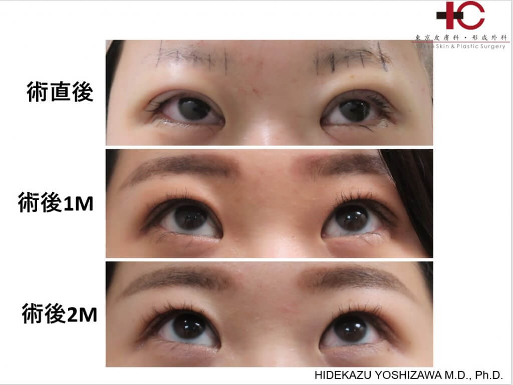 瞼の手術は奥が深い Dr Hideyoshi Blogdr Hideyoshi Blog