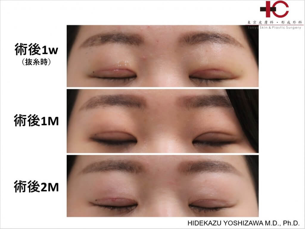 瞼の手術は奥が深い Dr Hideyoshi Blogdr Hideyoshi Blog