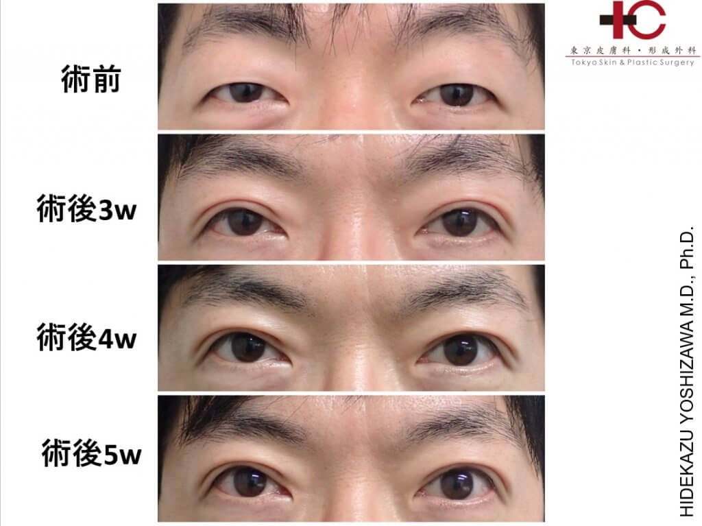 目 の 腫れ を 直す 方法